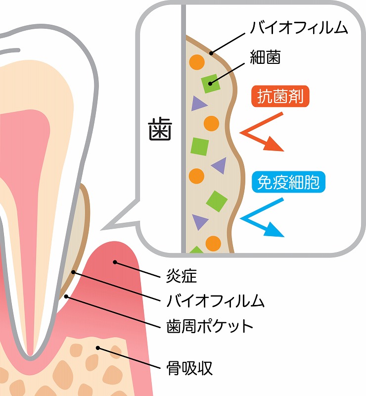 歯周病とは