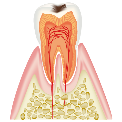 C1表面のエナメル質に穴が空いたむし歯