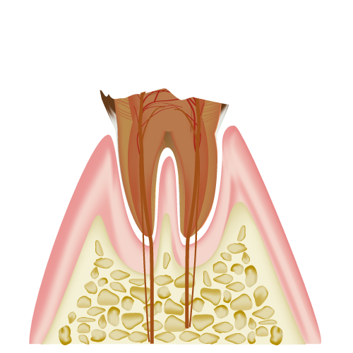 C4歯冠の大部分を失った状態