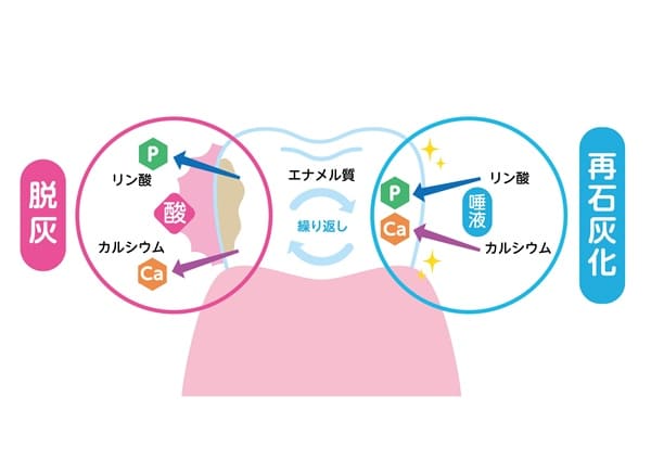 フッ素塗布による歯の再石灰化